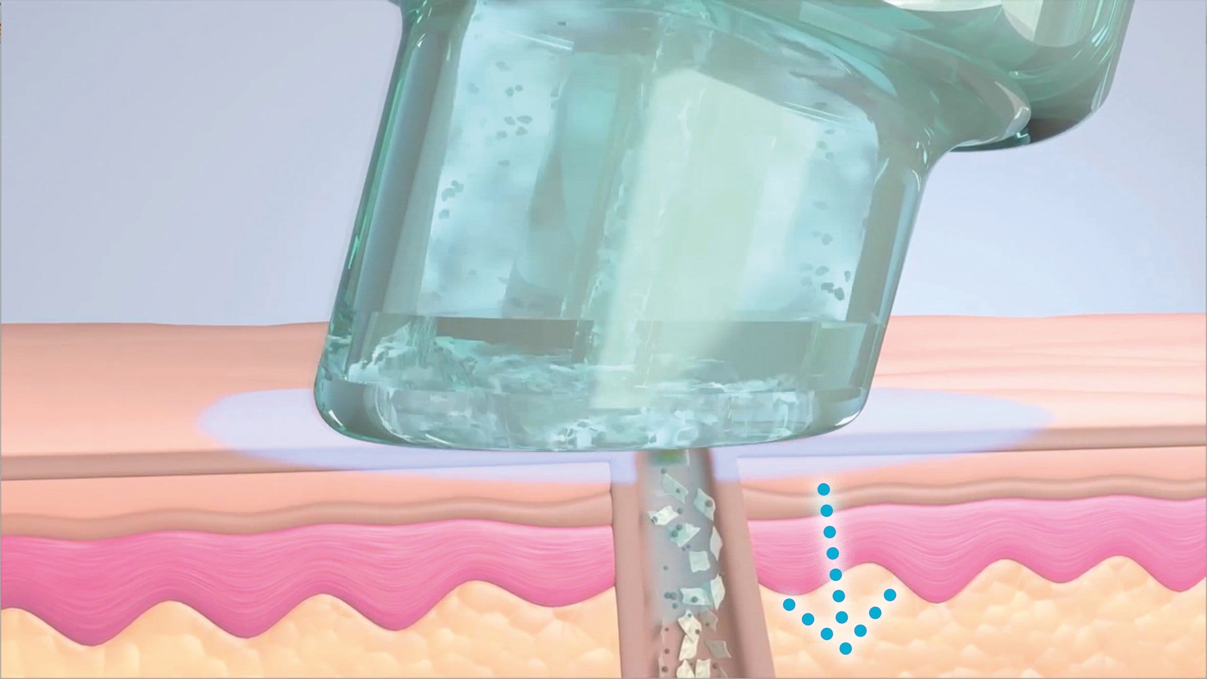 Hydrafacial Berlin Schmargendorf glysal säure peeling step 2