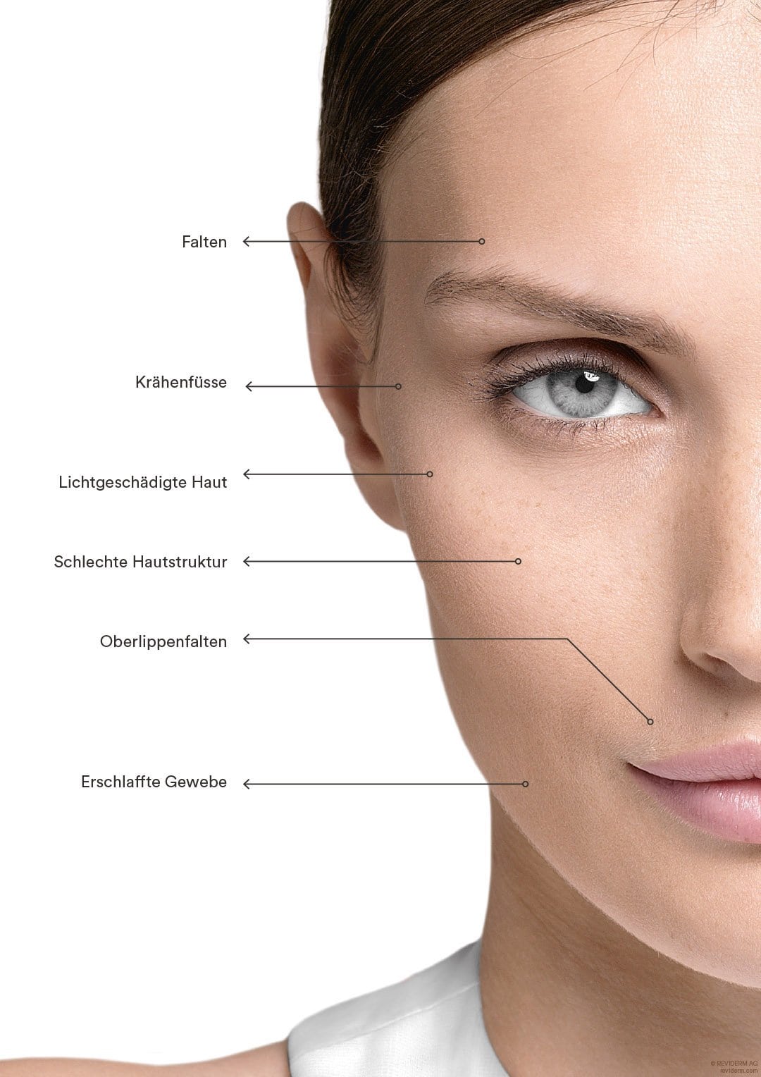 Reviderm Kosmetik Microneedling Skin Needler Hautindikationen
